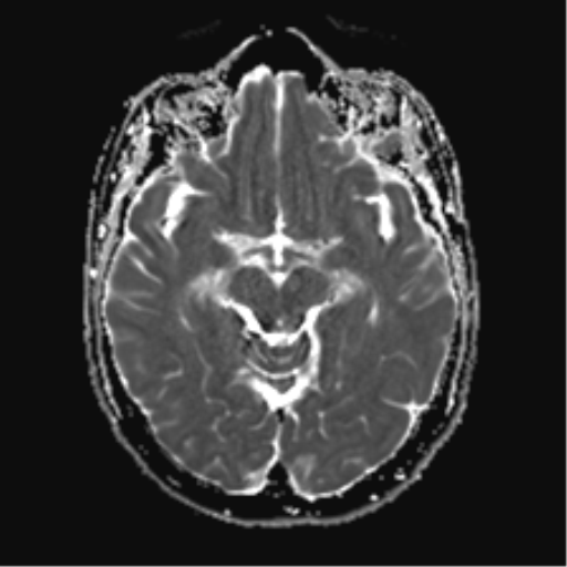 File:Anterior temporal lobe perivascular space (Radiopaedia 40946-43650 Axial ADC 11).png