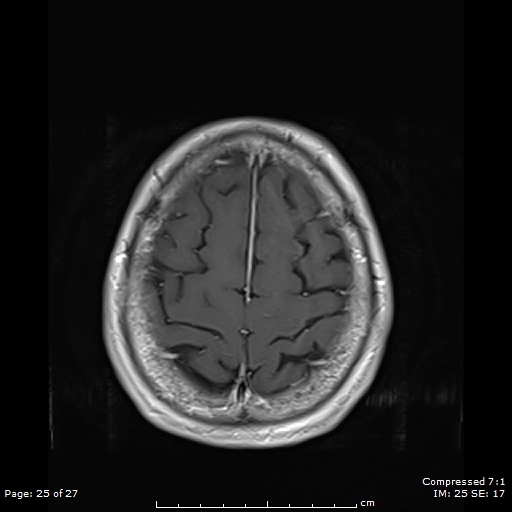 File:Anterior temporal lobe perivascular space (Radiopaedia 88283-104914 Axial T1 C+ 25).jpg