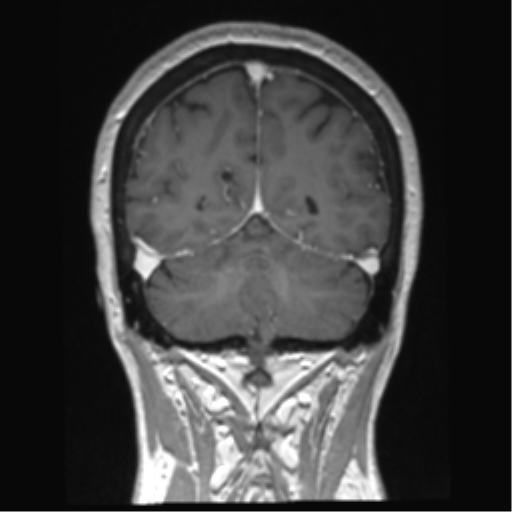 Anterior temporal pole cysts (Radiopaedia 46629-51102 Coronal T1 C+ 44).png
