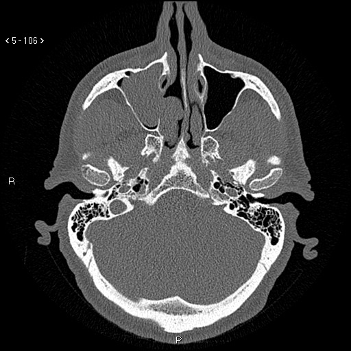 Antrochoanal Polyp (Radiopaedia 70510-80631 Axial bone window 54).jpg