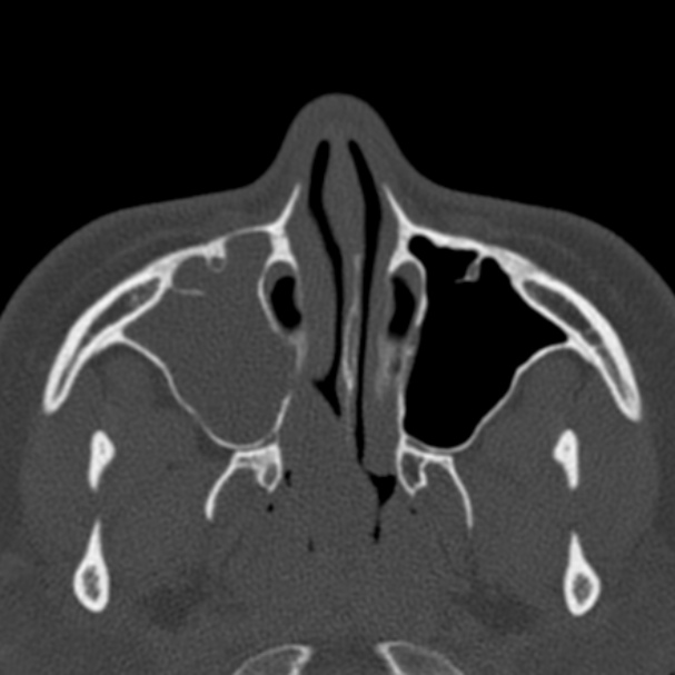 Antrochoanal polyp (Radiopaedia 33984-35202 Axial bone window 25).jpg