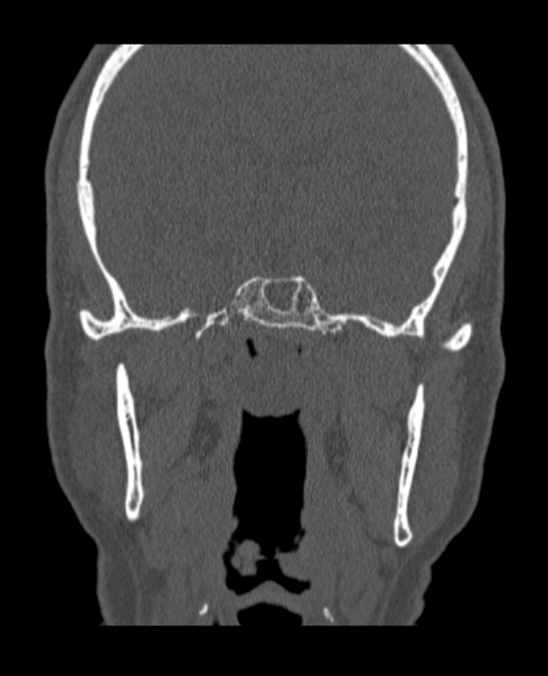Antrochoanal polyp (Radiopaedia 79011-92169 Coronal bone window 10).jpg