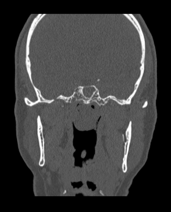 Antrochoanal polyp (Radiopaedia 79011-92169 Coronal bone window 13).jpg