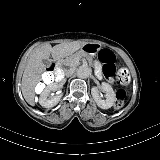 File:Aortic aneurysm and Lemmel syndrome (Radiopaedia 86499-102554 Axial C+ delayed 28).jpg