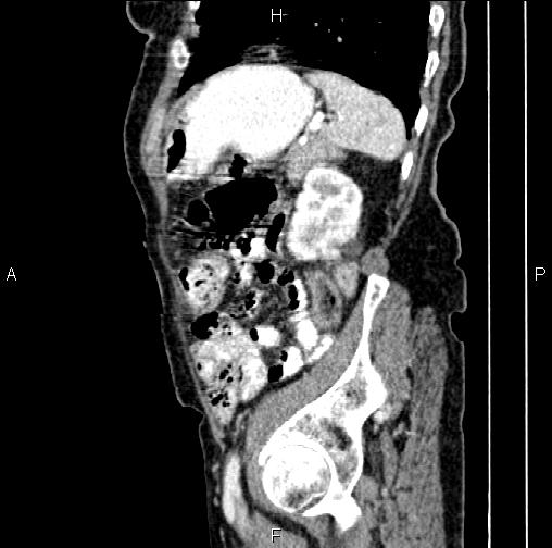 Aortic aneurysm and Lemmel syndrome (Radiopaedia 86499-102554 D 71).jpg