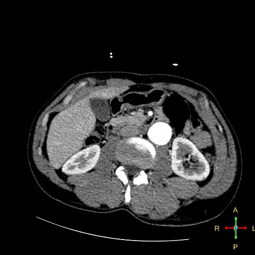 File:Aortic aneurysm and penetrating ulcer (Radiopaedia 23590-23704 A 35).jpg