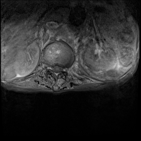 File:Aortic aneurysm with spinal destruction (Radiopaedia 42301-45409 Axial T1 fat sat 2).jpg