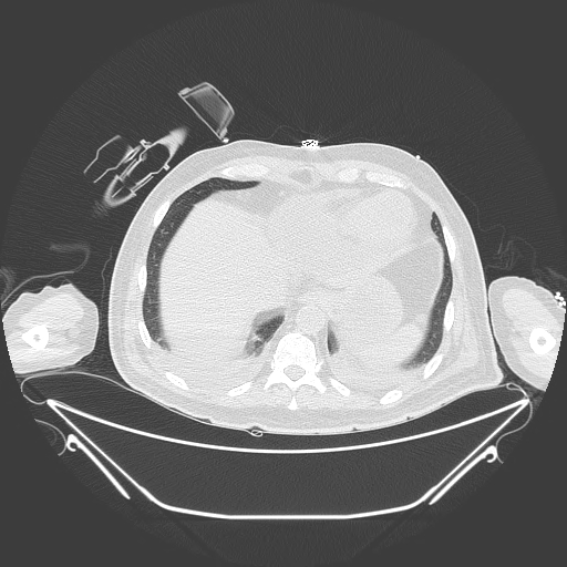 Aortic arch aneurysm (Radiopaedia 84109-99365 Axial lung window 229).jpg