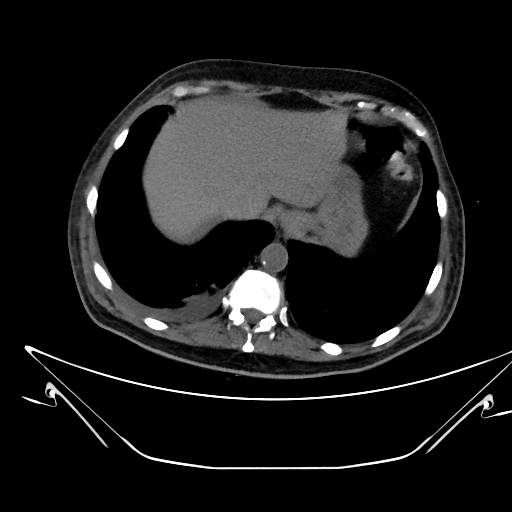 File:Aortic arch aneurysm (Radiopaedia 84109-99365 Axial non-contrast 242).jpg