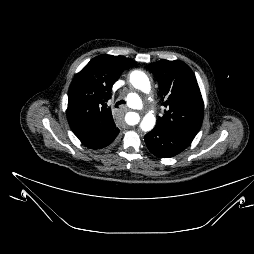 Aortic arch aneurysm (Radiopaedia 84109-99365 B 237).jpg