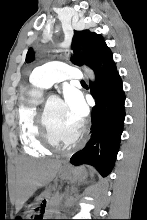 Aortic coarctation with aneurysm (Radiopaedia 74818-85828 B 98).jpg