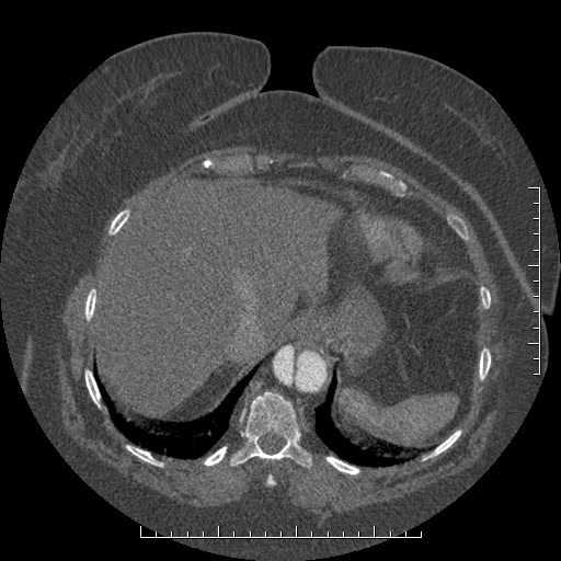 Aortic dissection- Stanford A (Radiopaedia 35729-37268 B 20).jpg