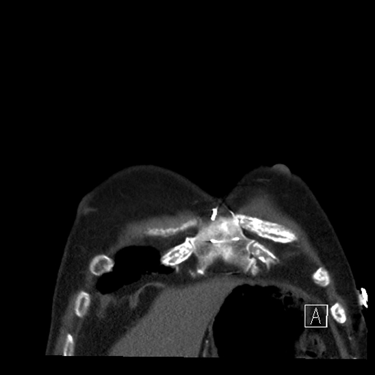 File:Aortic dissection (CTPA) (Radiopaedia 75506-86750 B 3).jpg