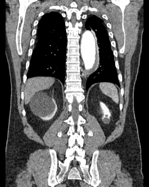 Aortic dissection (Radiopaedia 44411-48061 A 53).jpg