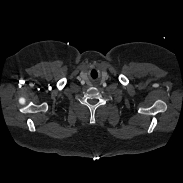 Aortic dissection (Radiopaedia 57969-64959 A 8).jpg