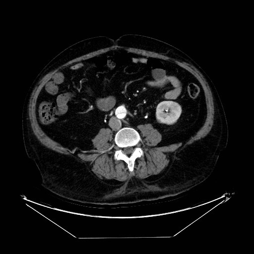 Aortic dissection (Radiopaedia 62562-71000 A 77).jpg