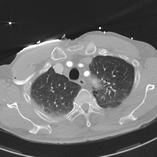 File:Aortic dissection - DeBakey type II (Radiopaedia 64302-73082 Axial lung window 13).png