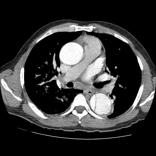 File:Aortic dissection - Stanford A -DeBakey I (Radiopaedia 28339-28587 B 41).jpg