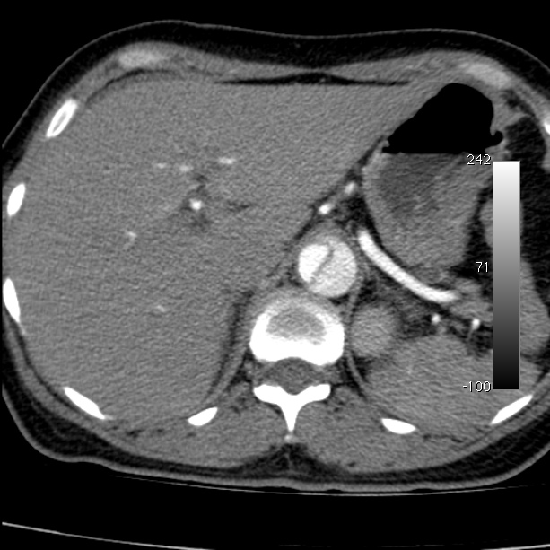 Aortic dissection - Stanford type A (Radiopaedia 29247-29659 A 74).jpg