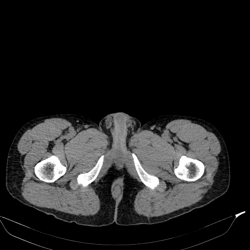 Aortic dissection - Stanford type A (Radiopaedia 83418-98500 Axial non-contrast 99).jpg