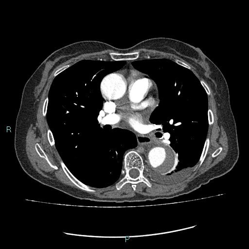 File:Aortic dissection extended to lusory artery (Radiopaedia 43686-47136 B 7).jpg
