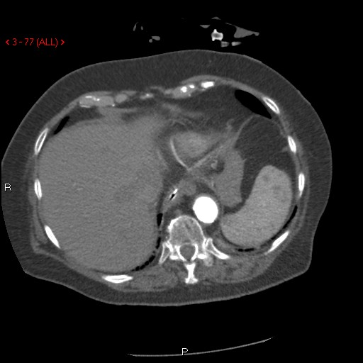 Aortic intramural hematoma (Radiopaedia 27746-28001 A 77).jpg