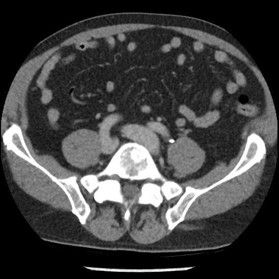 File:Aortic intramural hematoma (type B) (Radiopaedia 79323-92387 Axial C+ delayed 88).jpg