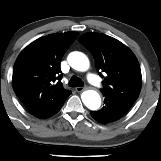 Aortic intramural hematoma (type B) (Radiopaedia 79323-92387 B 18).jpg