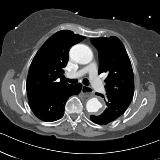 Aortic intramural hematoma from penetrating atherosclerotic ulcer (Radiopaedia 31137-31836 A 33).jpg
