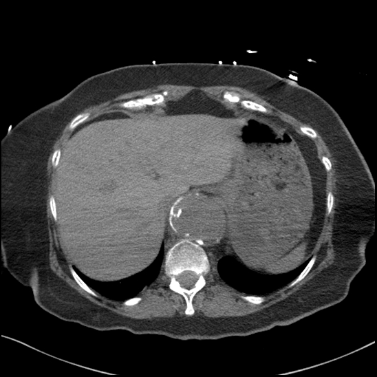 Aortic intramural hematoma with dissection and intramural blood pool (Radiopaedia 77373-89491 Axial non-contrast 87).jpg