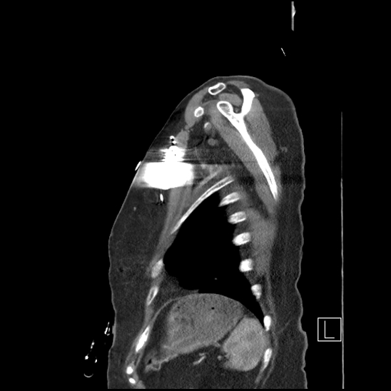 Aortic intramural hematoma with dissection and intramural blood pool (Radiopaedia 77373-89491 D 79).jpg
