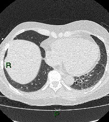 File:Aortic valve endocarditis (Radiopaedia 87209-103485 Axial lung window 73).jpg