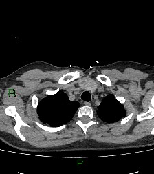 File:Aortic valve endocarditis (Radiopaedia 87209-103485 Axial non-contrast 18).jpg