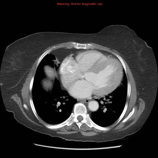 File:Aortic valve stenosis (Radiopaedia 14480-14423 C 13).jpg