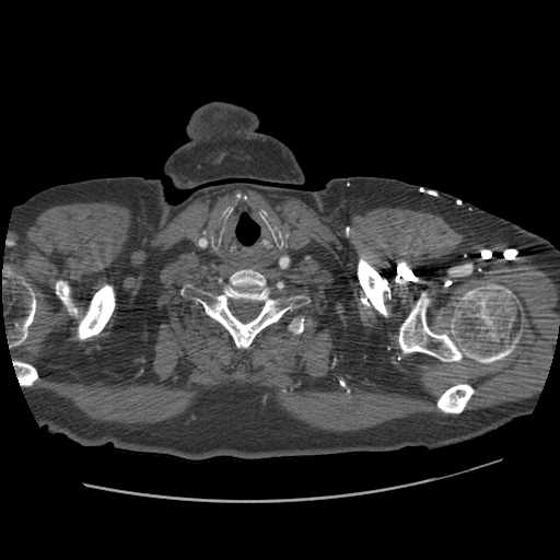 File:Aorto-coronary bypass graft aneurysms (Radiopaedia 40562-43157 A 8).png
