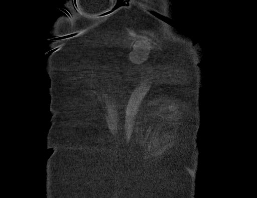 Aortoesophageal fistula with endovascular repair (Radiopaedia 73781-84592 Coronal C+ CTPA 141).jpg
