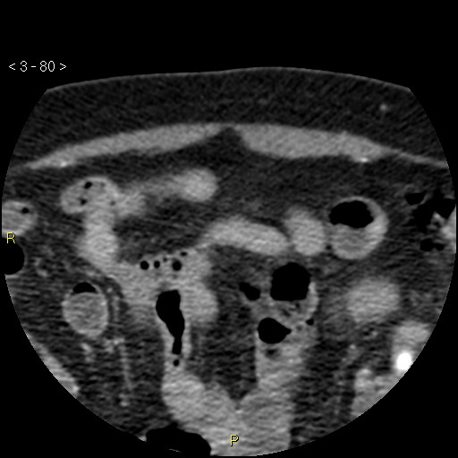 Aortoiliac occlusive disease (Radiopaedia 16828-16548 A 80).jpg