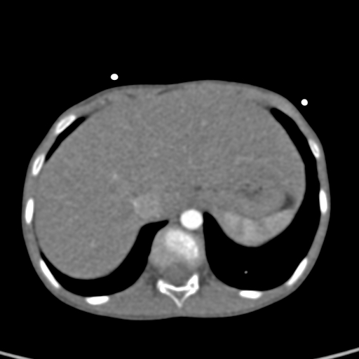 File:Aortopulmonary window, interrupted aortic arch and large PDA giving the descending aorta (Radiopaedia 35573-37074 B 86).jpg