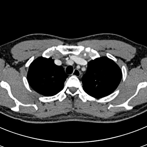 Apical lung mass mimic - neurogenic tumor (Radiopaedia 59918-67521 A 16).jpg