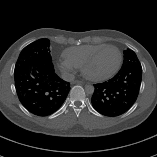 Apical lung mass mimic - neurogenic tumor (Radiopaedia 59918-67521 Axial bone window 58).jpg