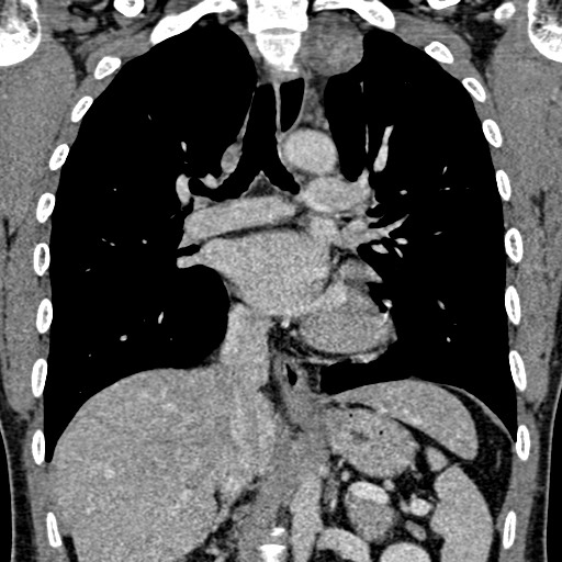 File:Apical lung mass mimic - neurogenic tumor (Radiopaedia 59918-67521 B 65).jpg