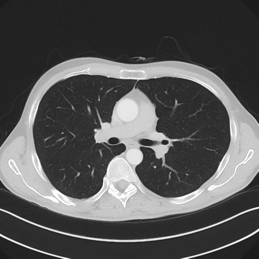 Apical pleural calcification (Radiopaedia 46141-50499 Axial lung window 30).png