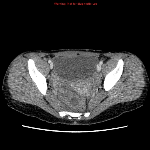 File:Appendiceal abscess (Radiopaedia 13096-13151 A 7).jpg