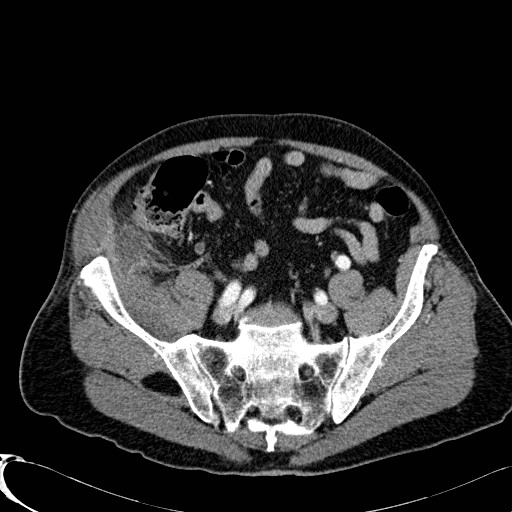 File:Appendiceal adenocarcinoma complicated by retroperitoneal abscess (Radiopaedia 58007-65039 B 107).jpg