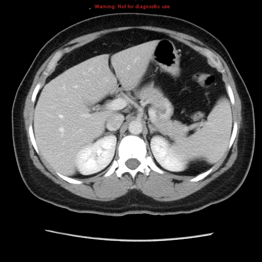 Appendiceal mucinous cystadenoma (Radiopaedia 8263-9111 Axial liver window 26).jpg