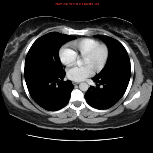 Appendiceal mucinous cystadenoma (Radiopaedia 8263-9111 Axial liver window 5).jpg
