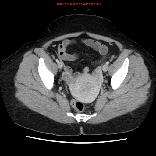 Appendiceal mucinous cystadenoma (Radiopaedia 8263-9111 Axial liver window 69).jpg
