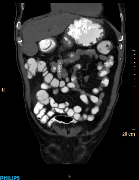 Appendiceal mucocoele (Radiopaedia 29449-29917 E 45).jpg
