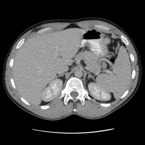 File:Appendicitis complicated by post-operative collection (Radiopaedia 35595-37113 A 15).jpg