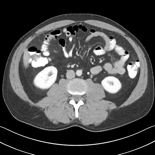 File:Appendicitis with cecal bar sign (Radiopaedia 31878-32830 B 42).jpg
